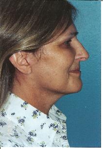 Facelift After Photo by Walter Sorokolit, MD; Fort Worth, TX - Case 7347
