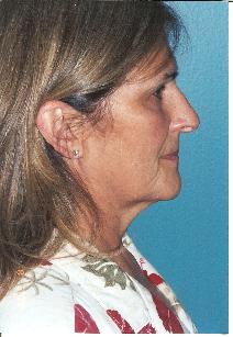 Facelift Before Photo by Walter Sorokolit, MD; Fort Worth, TX - Case 7347