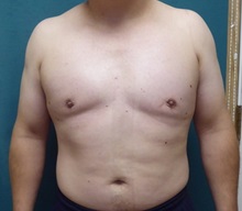 Male Breast Reduction After Photo by M. Vincent Makhlouf, MD, FACS; Des Plaines, IL - Case 31338