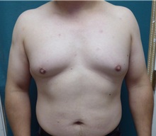 Male Breast Reduction Before Photo by M. Vincent Makhlouf, MD, FACS; Des Plaines, IL - Case 31338