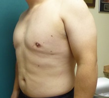 Male Breast Reduction After Photo by M. Vincent Makhlouf, MD, FACS; Des Plaines, IL - Case 31338
