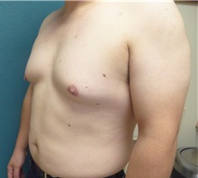 Male Breast Reduction Before Photo by M. Vincent Makhlouf, MD, FACS; Des Plaines, IL - Case 31338