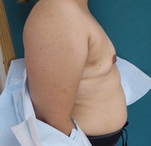 Breast Augmentation Before Photo by M. Vincent Makhlouf, MD, FACS; Des Plaines, IL - Case 31366