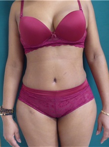 Tummy Tuck After Photo by M. Vincent Makhlouf, MD, FACS; Des Plaines, IL - Case 31368