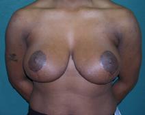 Breast Reduction After Photo by M. Vincent Makhlouf, MD, FACS; Des Plaines, IL - Case 9362