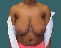 Breast Reduction Before Photo by M. Vincent Makhlouf, MD, FACS; Des Plaines, IL - Case 9362