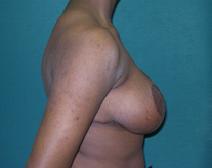 Breast Reduction After Photo by M. Vincent Makhlouf, MD, FACS; Des Plaines, IL - Case 9362