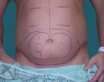 Liposuction Before Photo by M. Vincent Makhlouf, MD, FACS; Des Plaines, IL - Case 9366