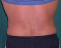 Liposuction After Photo by M. Vincent Makhlouf, MD, FACS; Des Plaines, IL - Case 9366