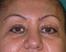 Eyelid Surgery After Photo by M. Vincent Makhlouf, MD, FACS; Des Plaines, IL - Case 9816