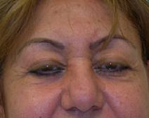 Eyelid Surgery Before Photo by M. Vincent Makhlouf, MD, FACS; Des Plaines, IL - Case 9816