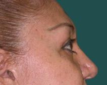 Eyelid Surgery After Photo by M. Vincent Makhlouf, MD, FACS; Des Plaines, IL - Case 9816