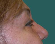 Eyelid Surgery Before Photo by M. Vincent Makhlouf, MD, FACS; Des Plaines, IL - Case 9816