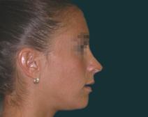 Rhinoplasty After Photo by M. Vincent Makhlouf, MD, FACS; Des Plaines, IL - Case 9818