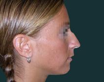 Rhinoplasty Before Photo by M. Vincent Makhlouf, MD, FACS; Des Plaines, IL - Case 9818