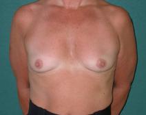 Breast Augmentation Before Photo by M. Vincent Makhlouf, MD, FACS; ,  - Case 9821