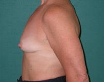 Breast Augmentation Before Photo by M. Vincent Makhlouf, MD, FACS; ,  - Case 9821