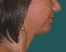 Facelift After Photo by M. Vincent Makhlouf, MD, FACS; Des Plaines, IL - Case 9822