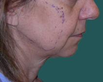 Facelift Before Photo by M. Vincent Makhlouf, MD, FACS; Des Plaines, IL - Case 9822