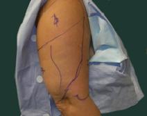 Arm Lift Before Photo by M. Vincent Makhlouf, MD, FACS; Des Plaines, IL - Case 9823