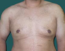 Male Breast Reduction After Photo by M. Vincent Makhlouf, MD, FACS; Des Plaines, IL - Case 9824