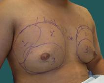 Male Breast Reduction Before Photo by M. Vincent Makhlouf, MD, FACS; Des Plaines, IL - Case 9824