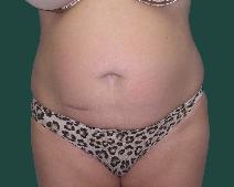 Tummy Tuck Before Photo by M. Vincent Makhlouf, MD, FACS; Des Plaines, IL - Case 9825