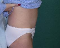 Tummy Tuck After Photo by M. Vincent Makhlouf, MD, FACS; Des Plaines, IL - Case 9825