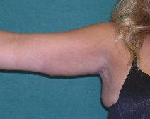 Arm Lift After Photo by M. Vincent Makhlouf, MD, FACS; Des Plaines, IL - Case 9828