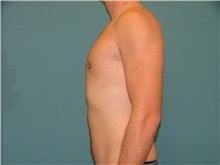 Male Breast Reduction After Photo by Arturo Guiloff, MD; Palm Beach Gardens, FL - Case 31153