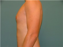 Male Breast Reduction Before Photo by Arturo Guiloff, MD; Palm Beach Gardens, FL - Case 31153