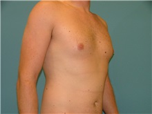 Male Breast Reduction Before Photo by Arturo Guiloff, MD; Palm Beach Gardens, FL - Case 31153