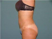 Liposuction After Photo by Arturo Guiloff, MD; Palm Beach Gardens, FL - Case 31157