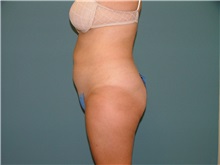 Liposuction Before Photo by Arturo Guiloff, MD; Palm Beach Gardens, FL - Case 31157