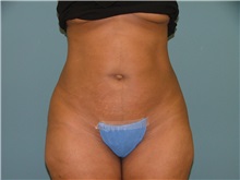 Liposuction After Photo by Arturo Guiloff, MD; Palm Beach Gardens, FL - Case 31158
