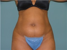 Liposuction Before Photo by Arturo Guiloff, MD; Palm Beach Gardens, FL - Case 31158