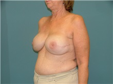 Breast Reconstruction After Photo by Arturo Guiloff, MD; Palm Beach Gardens, FL - Case 31160