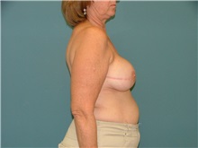 Breast Reconstruction After Photo by Arturo Guiloff, MD; Palm Beach Gardens, FL - Case 31160