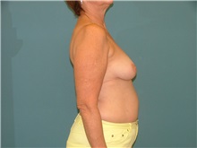 Breast Reconstruction Before Photo by Arturo Guiloff, MD; Palm Beach Gardens, FL - Case 31160