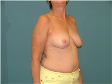Breast Reconstruction Before Photo by Arturo Guiloff, MD; Palm Beach Gardens, FL - Case 31160