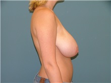 Breast Reduction Before Photo by Arturo Guiloff, MD; Palm Beach Gardens, FL - Case 31161
