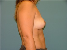 Breast Reduction After Photo by Arturo Guiloff, MD; Palm Beach Gardens, FL - Case 31162