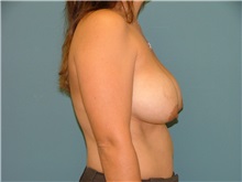 Breast Reduction Before Photo by Arturo Guiloff, MD; Palm Beach Gardens, FL - Case 31162