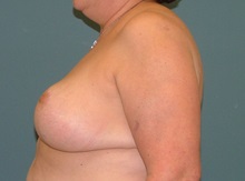 Breast Reduction After Photo by Arturo Guiloff, MD; Palm Beach Gardens, FL - Case 31163