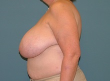 Breast Reduction Before Photo by Arturo Guiloff, MD; Palm Beach Gardens, FL - Case 31163