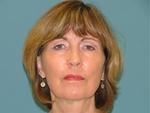 Chemical Peels, IPL, Fractional CO2 Laser Treatments After Photo by Arturo Guiloff, MD; Palm Beach Gardens, FL - Case 31166