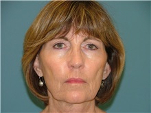 Chemical Peels, IPL, Fractional CO2 Laser Treatments Before Photo by Arturo Guiloff, MD; Palm Beach Gardens, FL - Case 31166