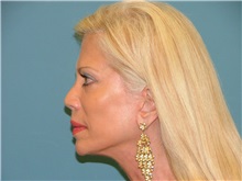 Facelift After Photo by Arturo Guiloff, MD; Palm Beach Gardens, FL - Case 31167
