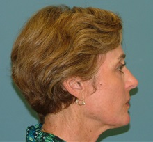 Chemical Peels, IPL, Fractional CO2 Laser Treatments After Photo by Arturo Guiloff, MD; Palm Beach Gardens, FL - Case 31169