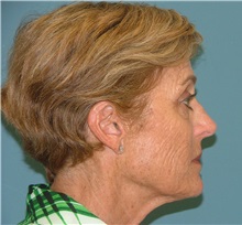 Chemical Peels, IPL, Fractional CO2 Laser Treatments Before Photo by Arturo Guiloff, MD; Palm Beach Gardens, FL - Case 31169